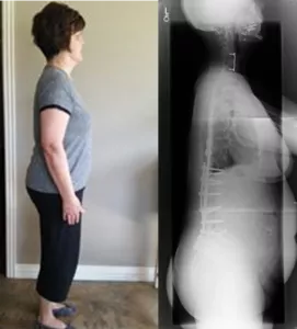 Judy after surgery standing and xray