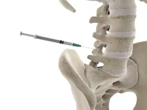 Lumbar spine injection, illustration