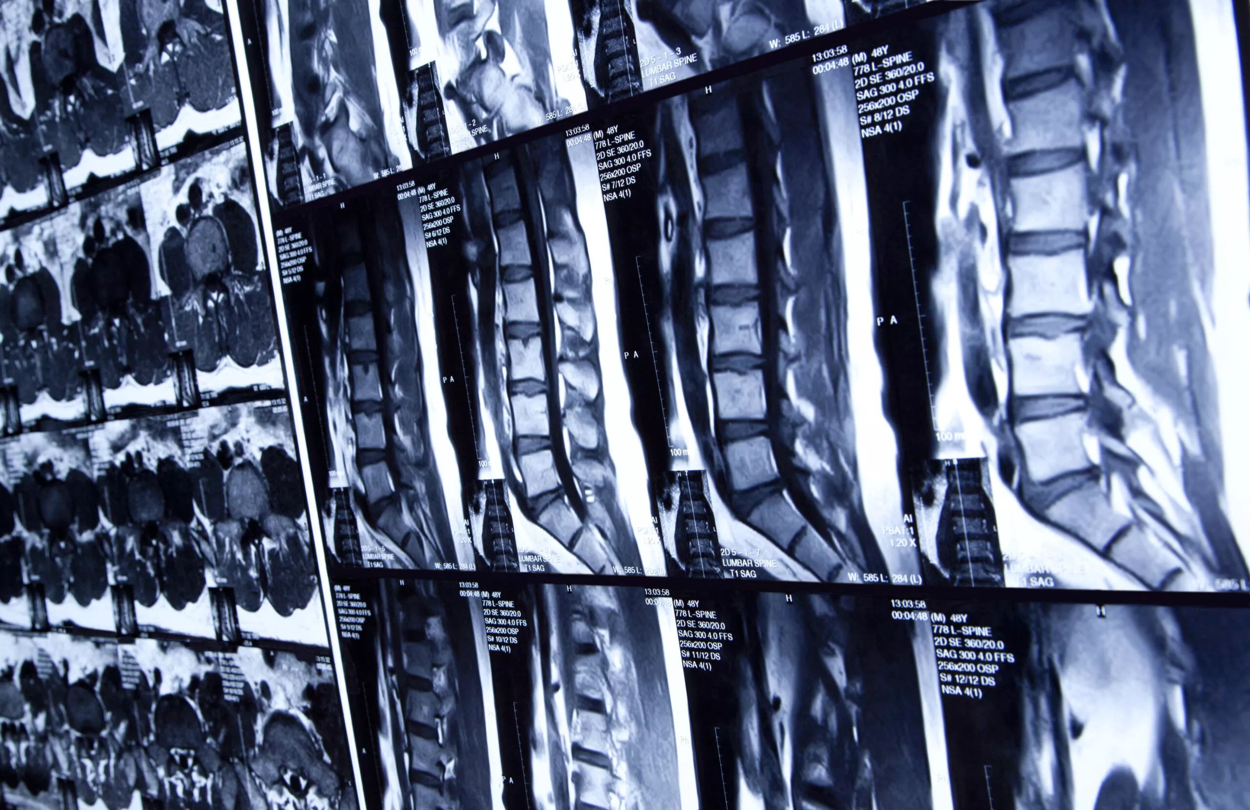 CT scan of human lumbar spine