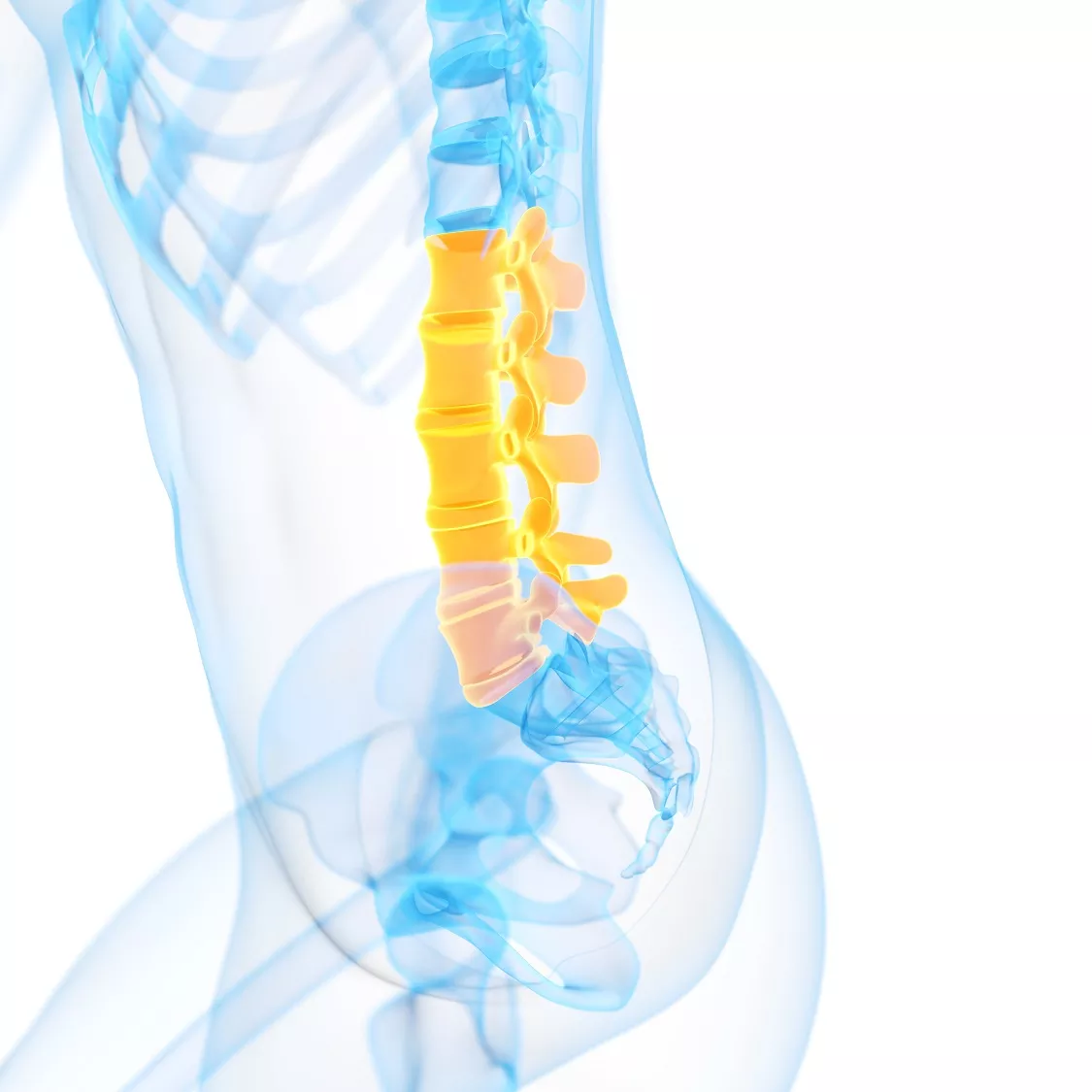 Lumbar spine, illustration of Laminectomy