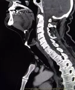 Cervical Spine CT Scan