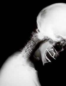 Cervical Kyphosis Xray 0 