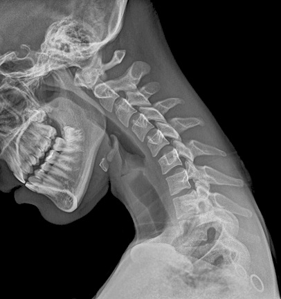 padle Sprede blok Cervical Radiculopathy | pinched nerve | Disc herniation | Bone Spurs