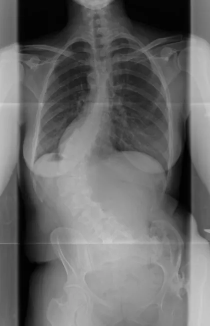 Scoliosis Pre surgery X-ray of Allen TX patient