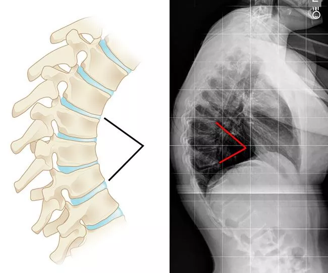 Lumbar Spinal Bracing, Non-Surgical Scheuermann's Kyphosis