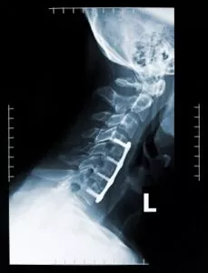 Close-up X-Ray of a pain in the neck