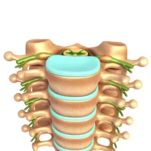Lumbar vertebrae pain needing Spondylolysis Treatment