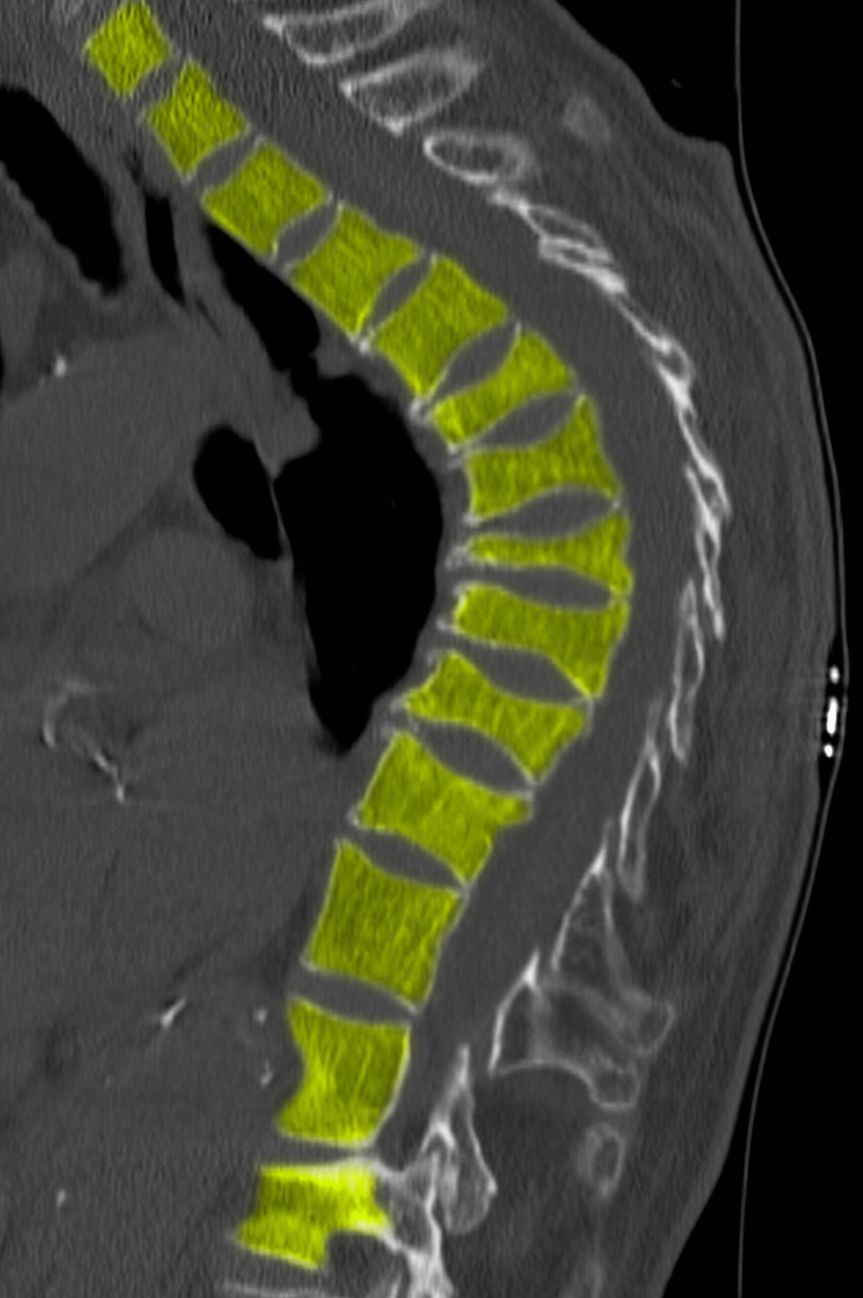 CT scan of thoracic spine