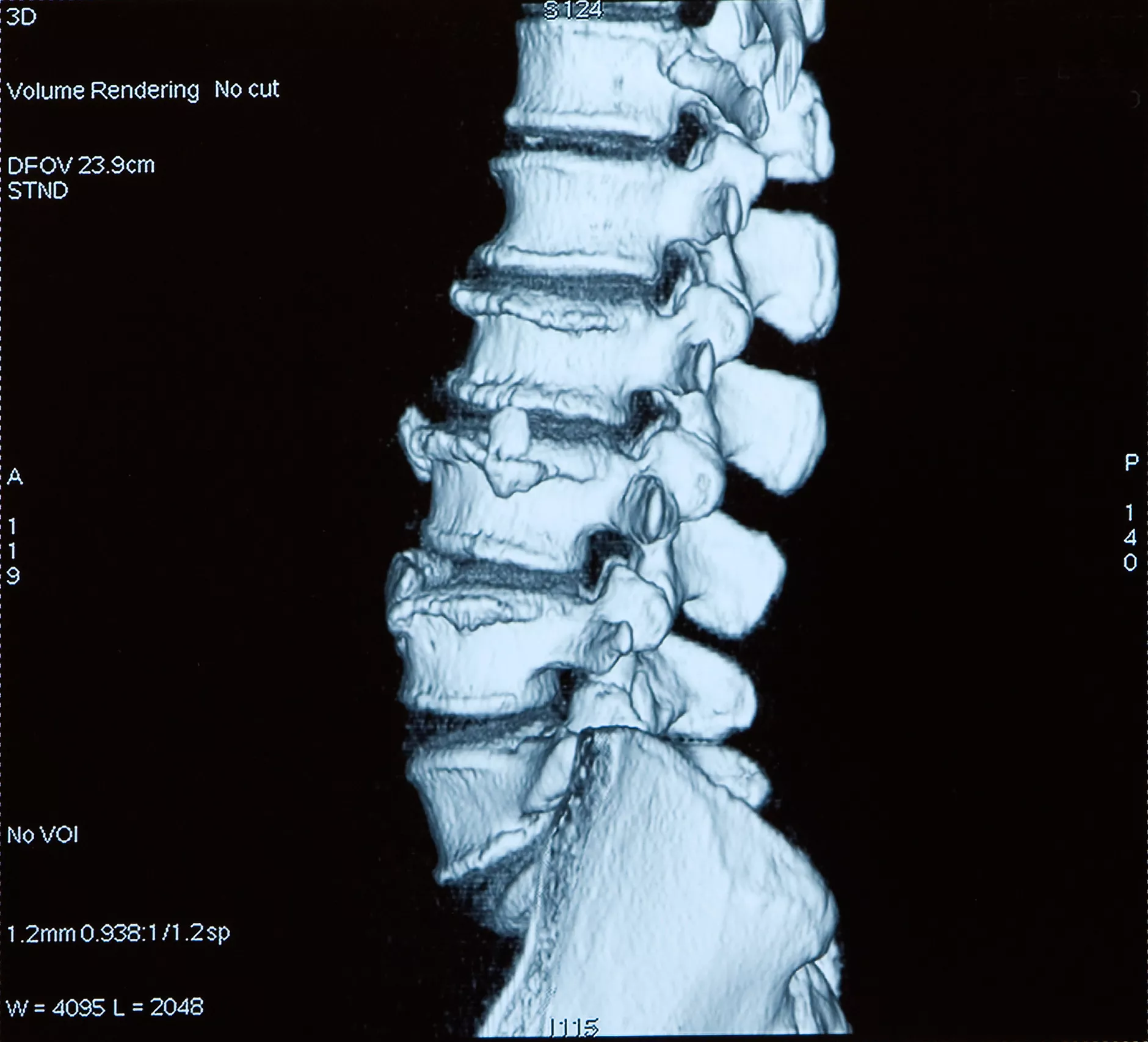Computerized Tomography of spine