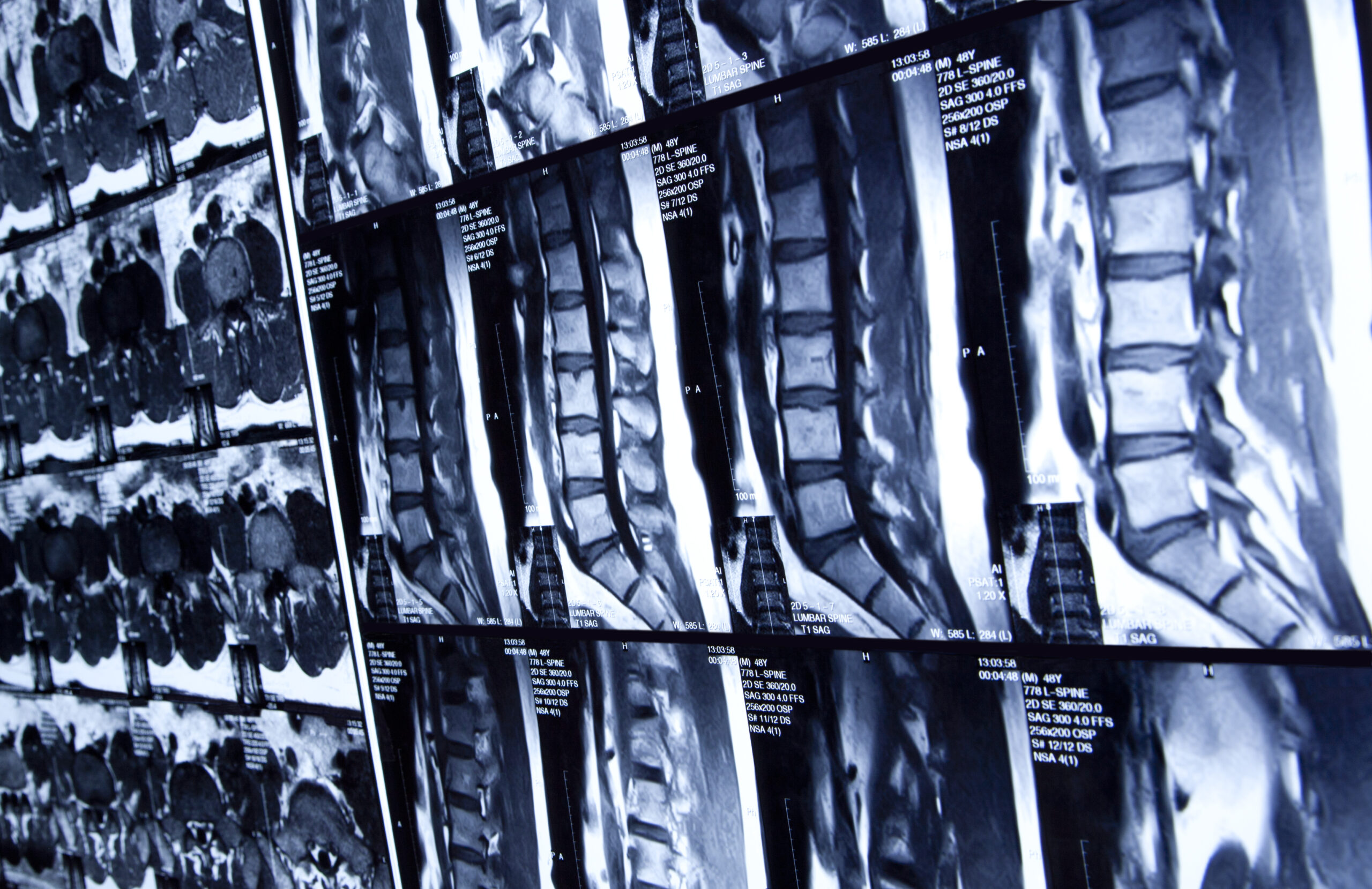 What is Spinal Stenosis?: The Spine Institute of Southeast Texas:  Orthopedic Surgeons