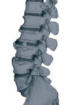 Lumbar Spine to show Wylie TX patients