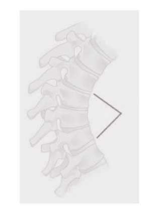 Spine kyphosis from shreveport la patient
