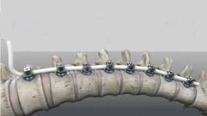 The Tether attached to a spine