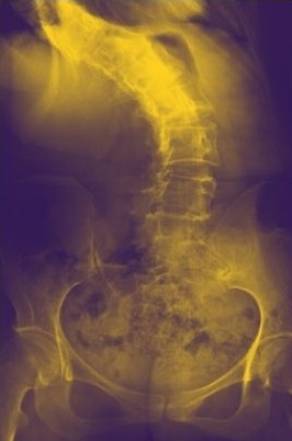 x ray of spine of a Wylie TX patient
