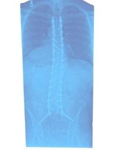 Xray scoliosis post surgery of a patient from McKinney TX