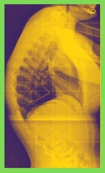 kyphosis spine xray with yellow