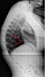 kyphosis spine of patient in shreveport la