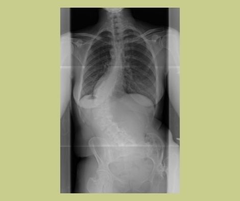 Spine with scoliosis of The Colony TX patient