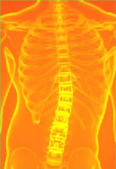 Scoliosis X-ray