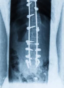 Spinal Fusion Surgery post surgery X-ray