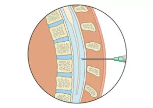 Digital illustration of lumbar injection for pain relief