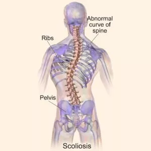 Severe Scoliosis