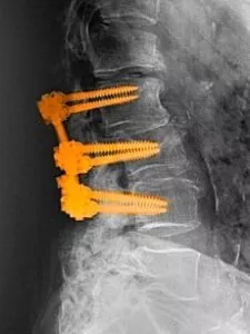 Spinal Fusion
