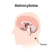 Astrocytoma