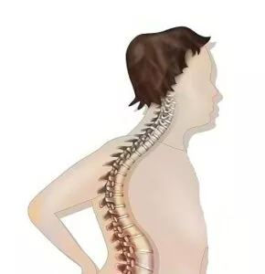 cervical kyphosis neck