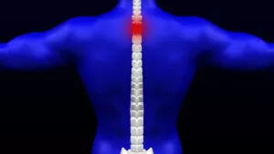 Spinal Cord Injury