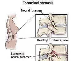 Cervical Foraminal Stenosis