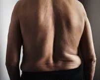 Degenerative Scoliosis