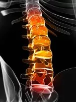 Spinal Osteoarthritis