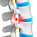cervical disc extrusion