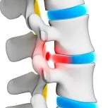 Thoracic Disc Extrusion