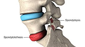 Spondylolisthesis