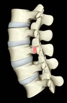 Facet Joint Syndrome