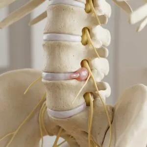 Herniated Disc