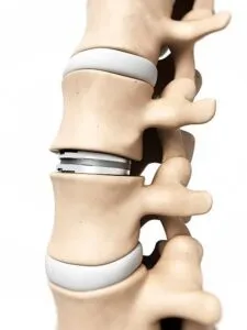 Artificial Disc Replacement
