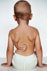 Infantile Scoliosis