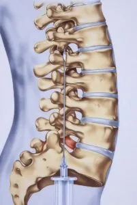 Spinal Tap