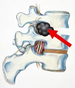 Spinal Tumor